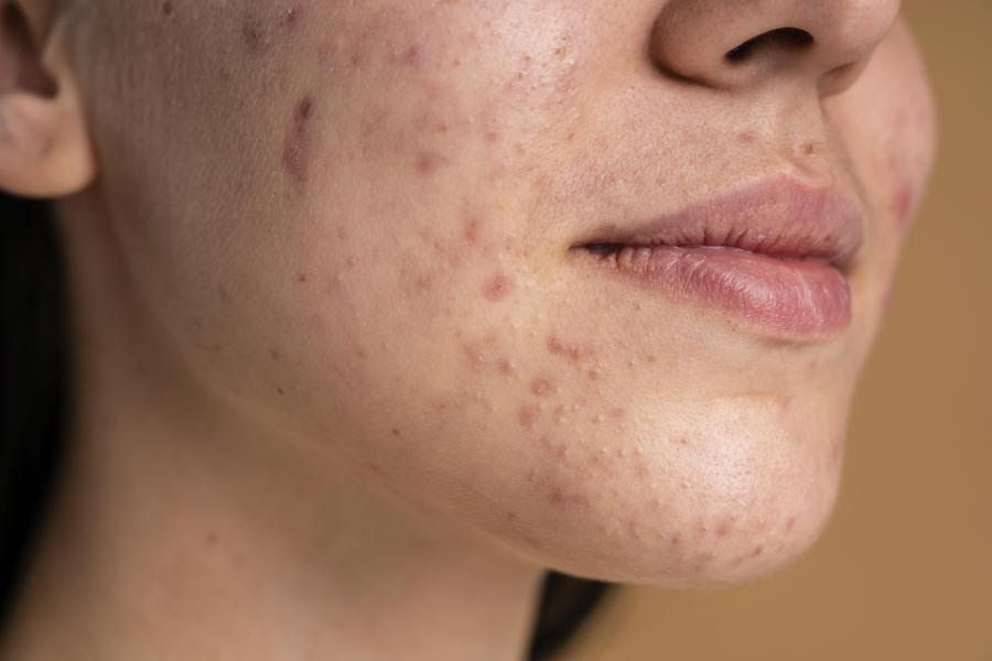 acne de calor