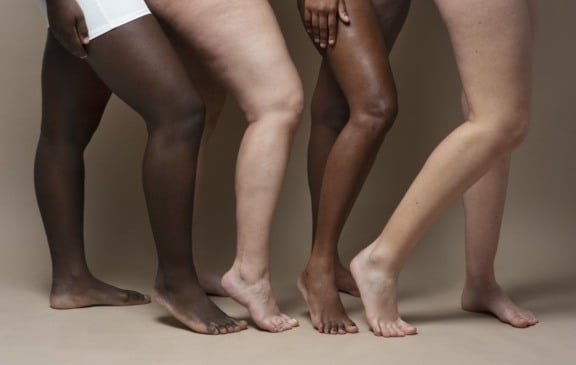 Conheça alguns dos sintomas silenciosos do lipedema que podem dificultar o diagnóstico