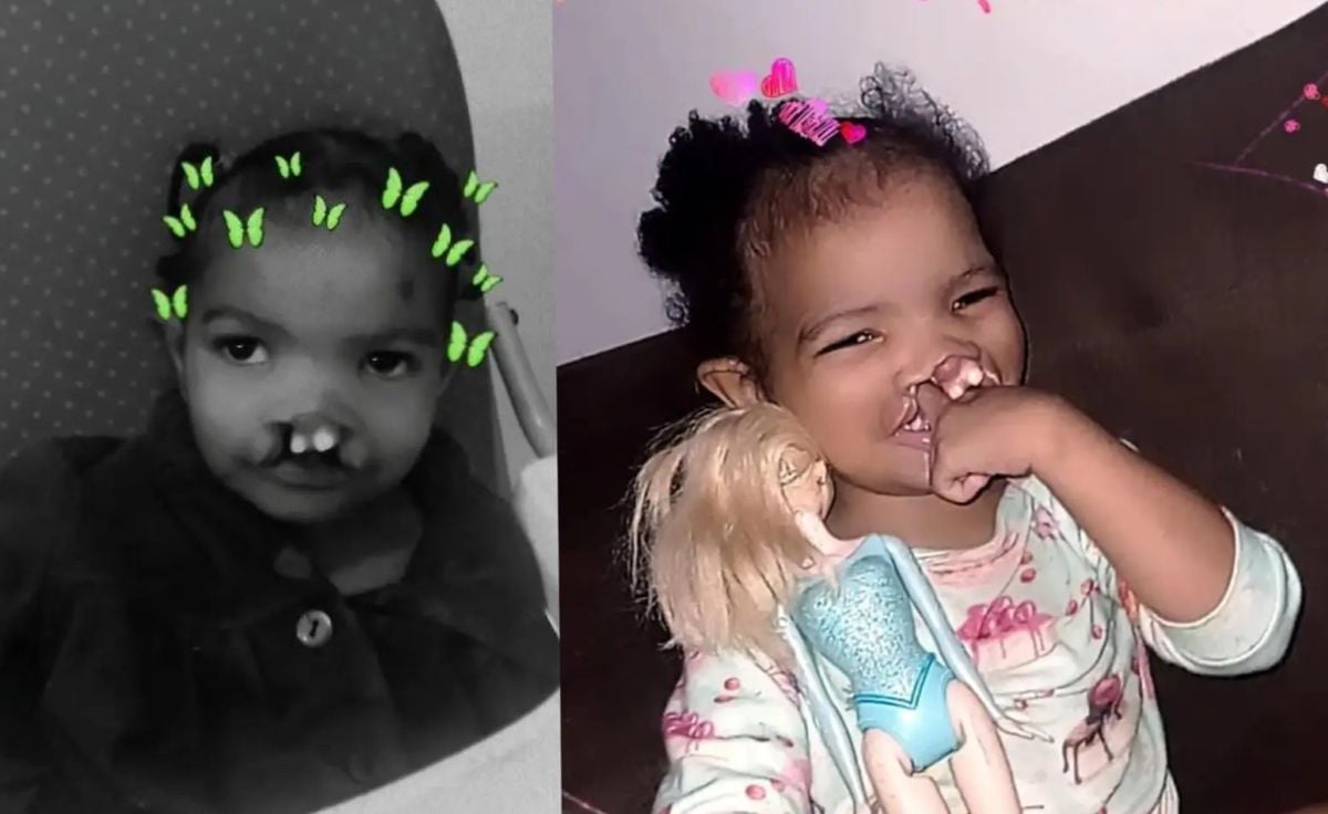 Laisla Eduarda: mãe pede ajuda para filha com lábio leporino, fenda palatina e microcefalia