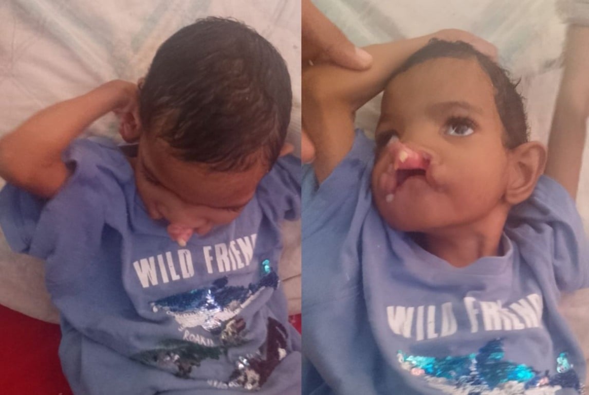 Laisla Eduarda: mãe pede ajuda para filha com lábio leporino, fenda palatina e microcefalia