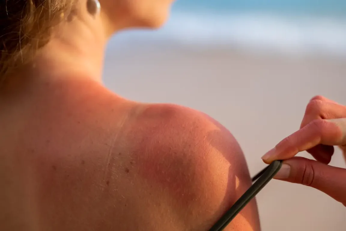Movimento anti protetor solar: dermatologista destaca os perigos para a saúde da pele
