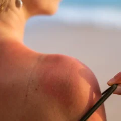 Movimento anti protetor solar: dermatologista destaca os perigos para a saúde da pele