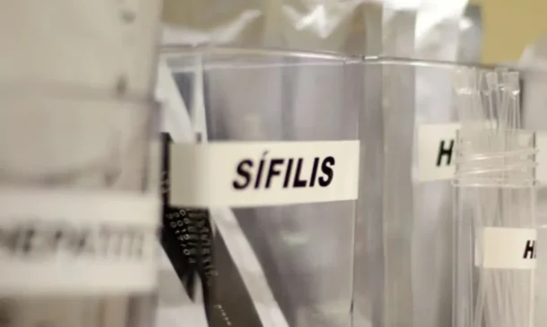 sífilis
