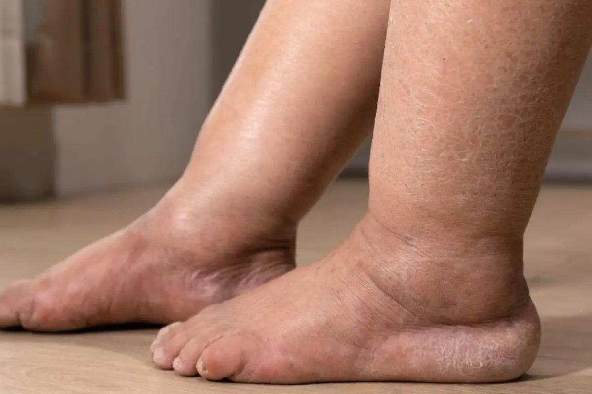 Inchaço nas pernas pode ser lipedema ou linfedema: saiba como identificar