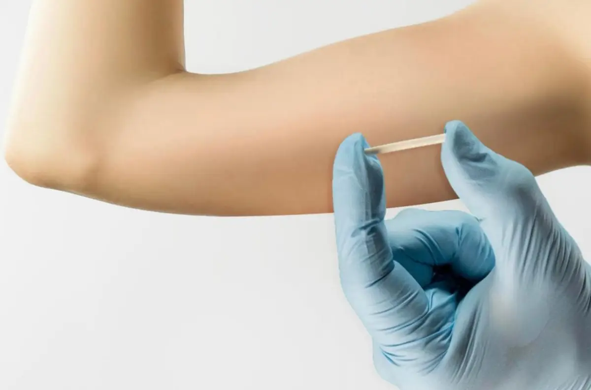 Implantes hormonais exigem cautela em mulheres com lipedema e podem agravar um quadro já difícil de diagnosticar