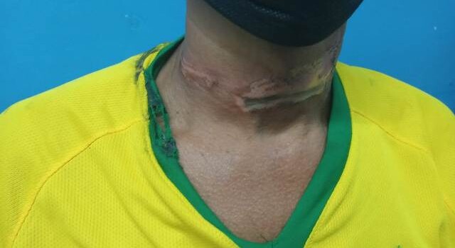 Motociclista é atingido no pescoço por fio de telefonia solto em via pública e socorrido para a Upa (Foto: Arquivo Pessoal)