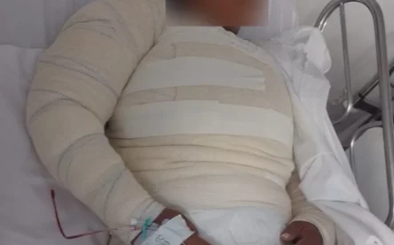 mulher corpo queimado água fervente