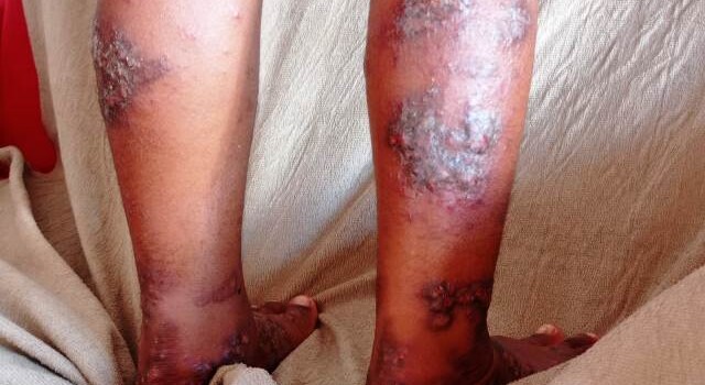 Garoto diagnosticado com dermatite atópica grave e sofre com as feridas e bolhas espalhadas pelo corpo. (Foto: Ed Santos/ Acorda Cidade)
