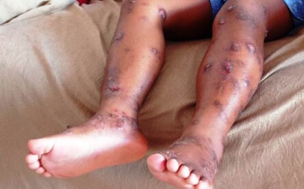 Garoto diagnosticado com dermatite atópica grave e sofre com as feridas e bolhas espalhadas pelo corpo. (Foto: Ed Santos/ Acorda Cidade)