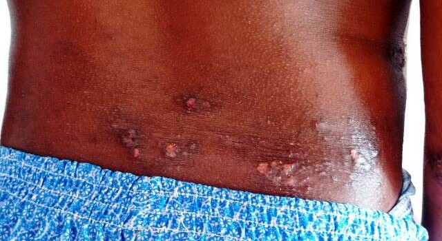 Garoto diagnosticado com dermatite atópica grave e sofre com as feridas e bolhas espalhadas pelo corpo. (Foto: Ed Santos/ Acorda Cidade)