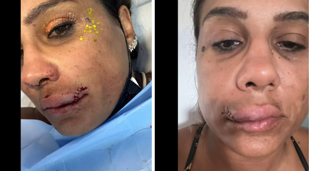 agressão soco murro médica carnaval 2023 salvador bloco da quinta 