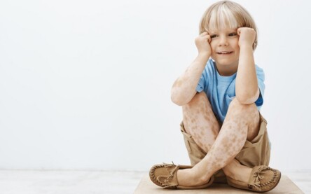 Vitiligo