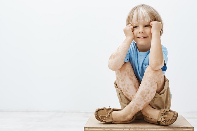 Vitiligo